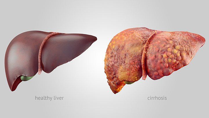 Damaged liver