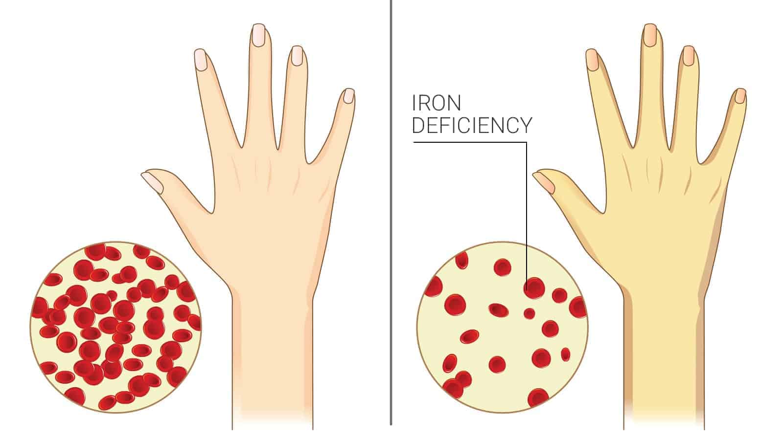 normal cells vs iron deficiency cell