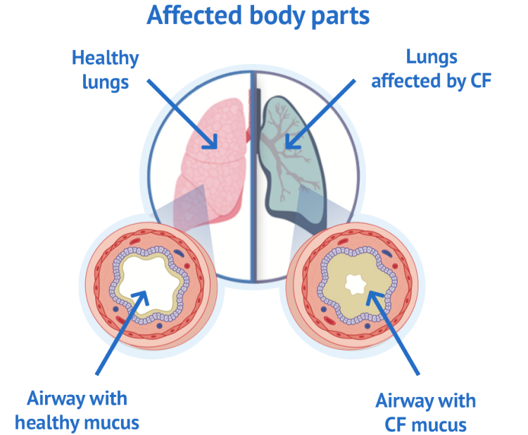 lung affected by CF 