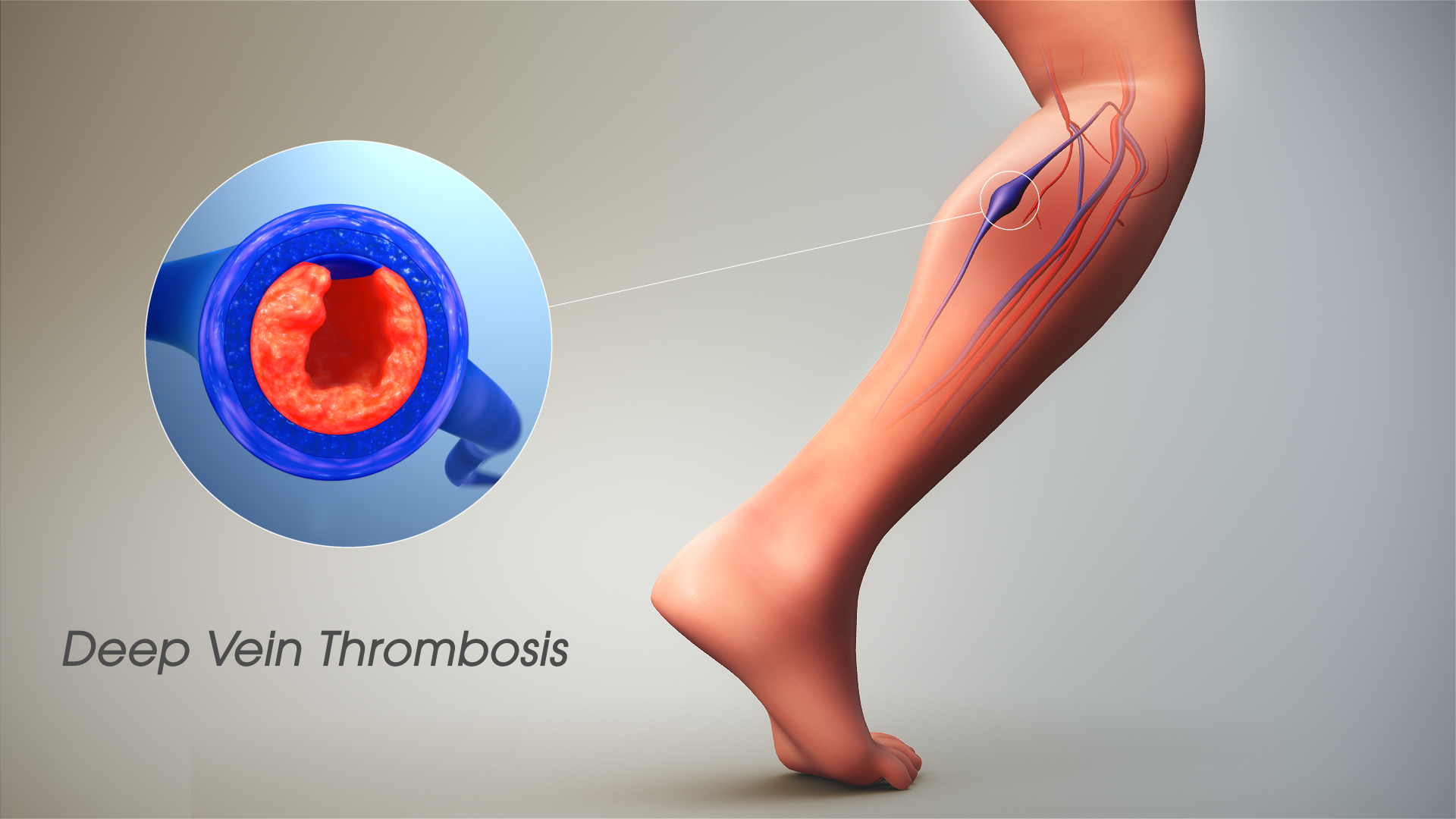 deep vein thrombosis in calf