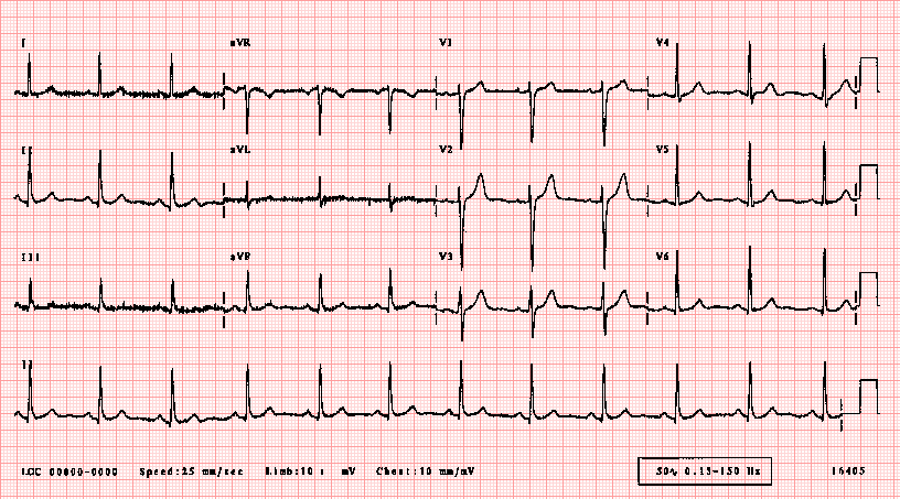 ECG