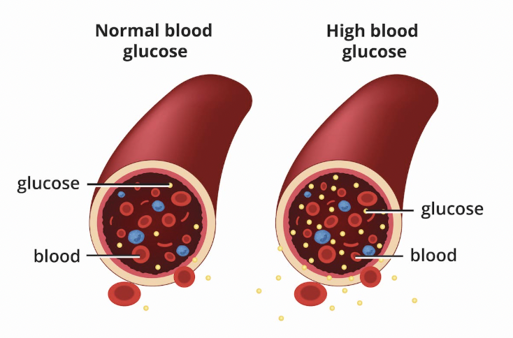 blood sugar