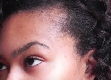 hair loss at edges