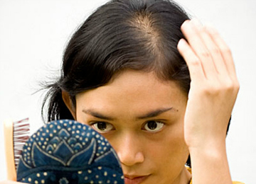 hair loss at part
