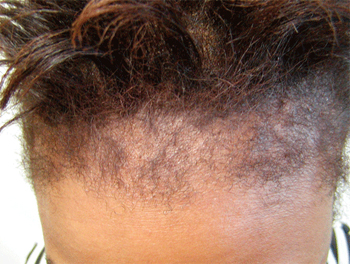 thin edges of hair at crown of head