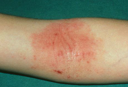 Emu oil relieves eczema flare ups