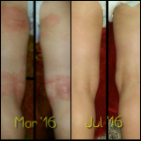 Before and after photos of Emu Joy products on child's eczema