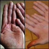 Before and after photos of eczema treated with emu oil