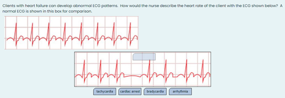 Clients with heart failure can develop abnormal ECG patterns. How would the