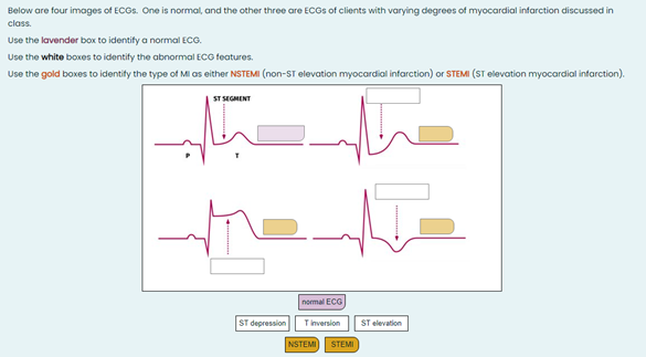 below? A normal ECO is shown in this box for comparison. tachycardia
