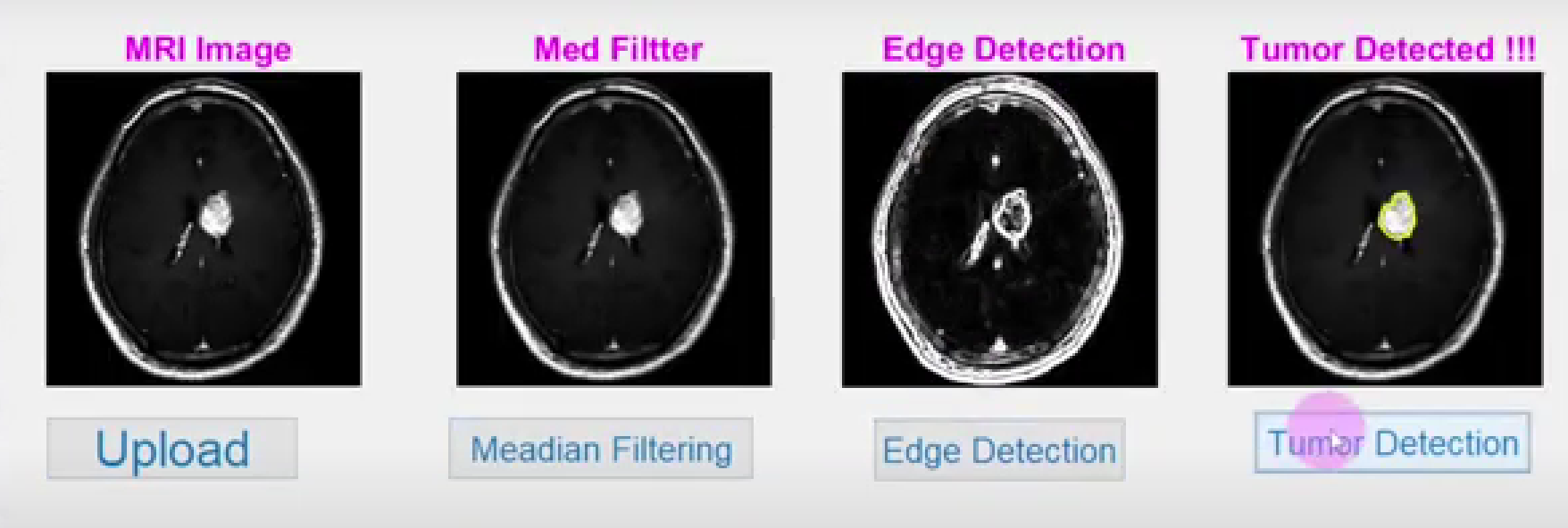 Write a Mathlab code that can detect brain tumours from brain