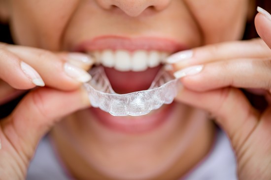 Invisalign Clear Braces 4