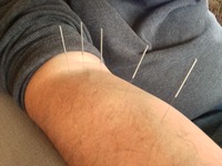 Back Pain