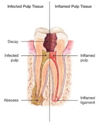 Root Canals-Endodontic Treatment Santa Barbara Dental Spa-2 Root Canals-Endodontic Treatment Santa Barbara Dental Spa-2