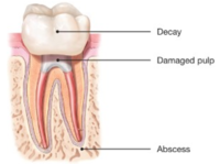 Root Canals-Endodontic Treatment Santa Barbara Dental Spa-3 Root Canals-Endodontic Treatment Santa Barbara Dental Spa-3