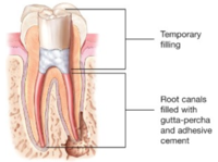 Root Canals-Endodontic Treatment Santa Barbara Dental Spa-4 Root Canals-Endodontic Treatment Santa Barbara Dental Spa-4