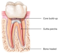 Root Canals-Endodontic Treatment Santa Barbara Dental Spa-5 Root Canals-Endodontic Treatment Santa Barbara Dental Spa-5