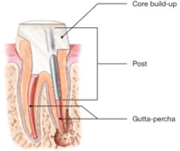 Root Canals-Endodontic Treatment Santa Barbara Dental Spa-6 Root Canals-Endodontic Treatment Santa Barbara Dental Spa-6