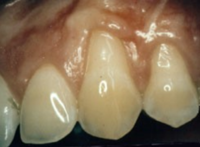 Before Gum Graft Surgery Before Gum Graft Surgery