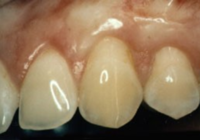 After Gum Graft Surgery After Gum Graft Surgery