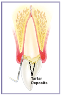 Mild Periodontitis Mild Periodontitis