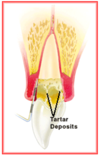 Advanced Periodontitis Advanced Periodontitis