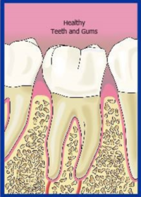 Gum Disease Gum Disease