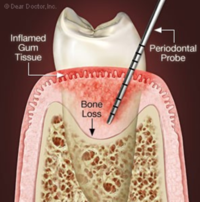 Oral Surgery Procedures Santa Barbara Dental Spa-2 Oral Surgery Procedures Santa Barbara Dental Spa-2