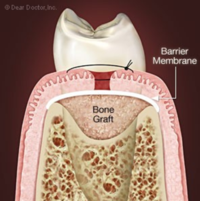 Oral Surgery Procedures Santa Barbara Dental Spa-3 Oral Surgery Procedures Santa Barbara Dental Spa-3