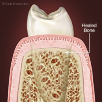 Oral Surgery Procedures Santa Barbara Dental Spa-4 Oral Surgery Procedures Santa Barbara Dental Spa-4