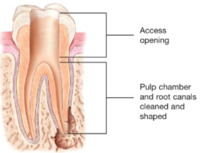 Root Canal Emergency Dental Services Root Canal Emergency Dental Services