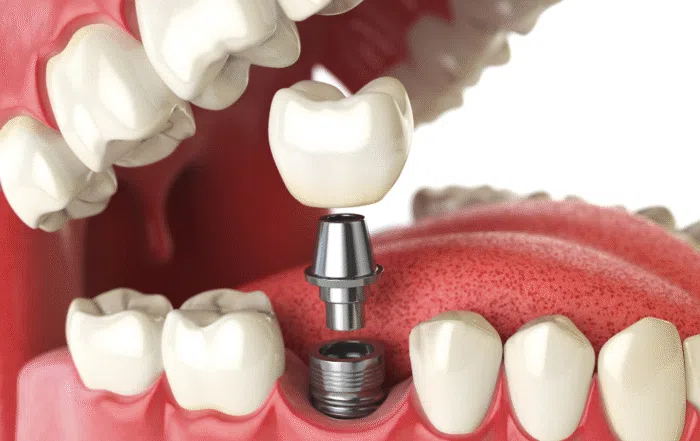 Dental Implants