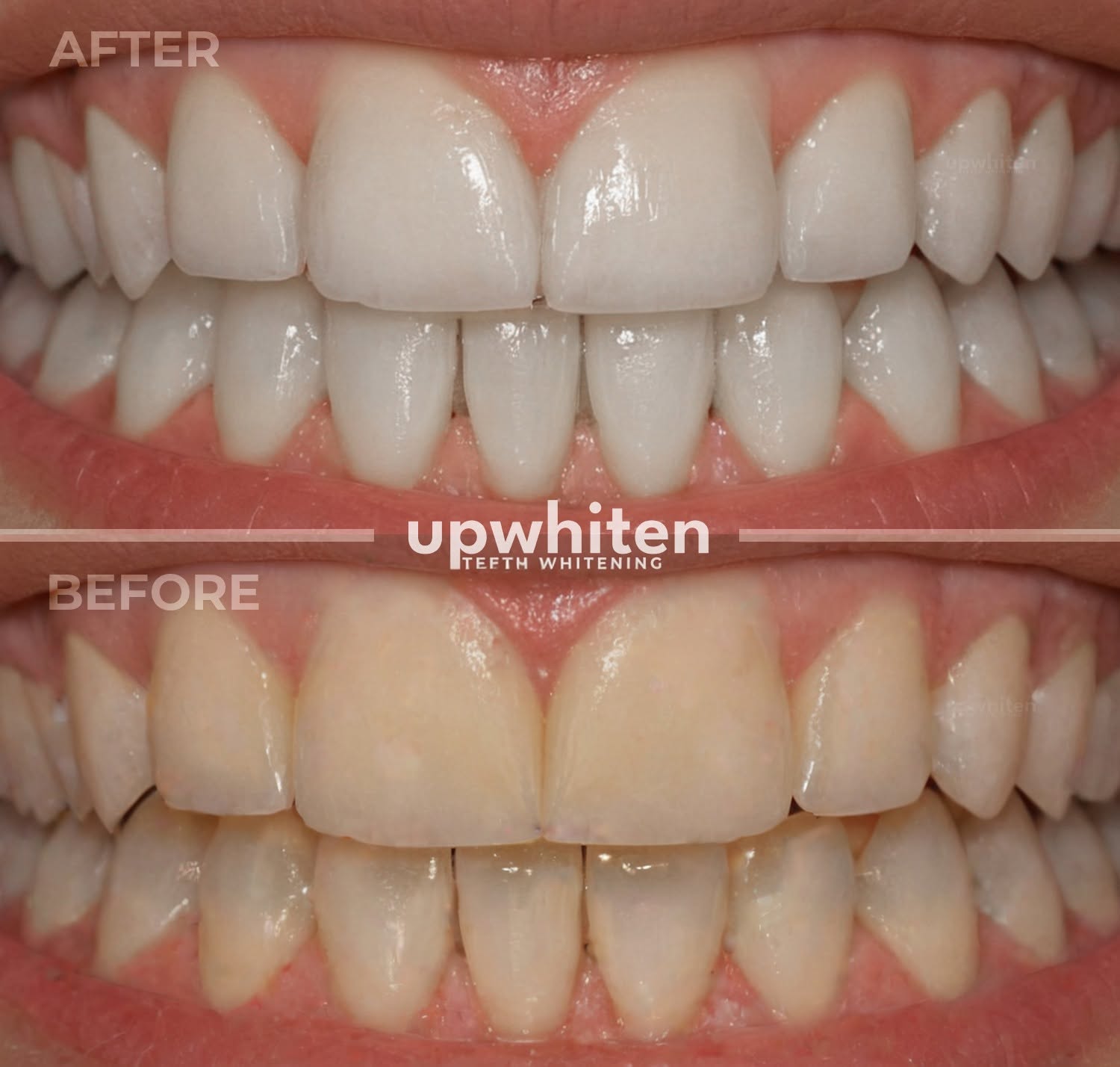UpWhiten Teeth Whitening - Teeth whitening service Ottawa, Canada