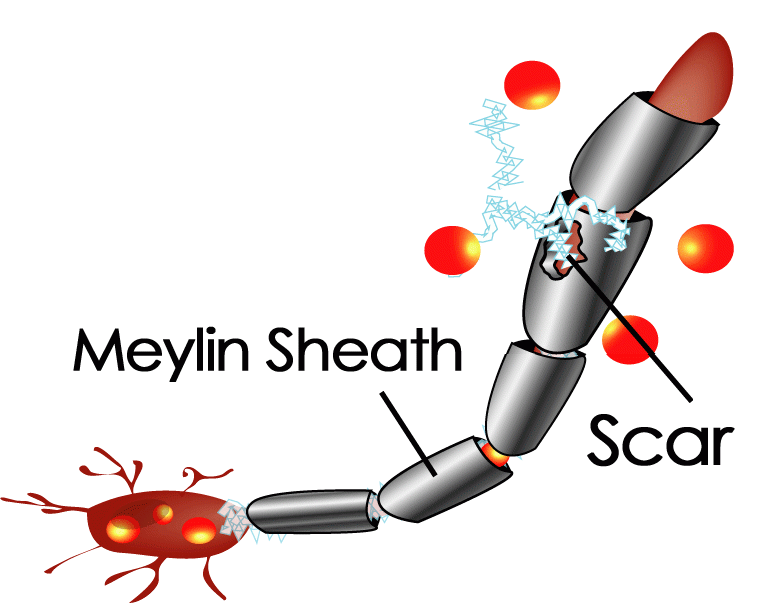 COURTESY OF WWW.REBUILDINGYOU.COM
Scientists find a link between low vitamin D level and severity of multiple sclerosis.