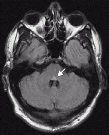 COURTESY OF WWW.NEUROLOGY.ORG
MRI images of multiple sclerosis patients were compared to retina scans.