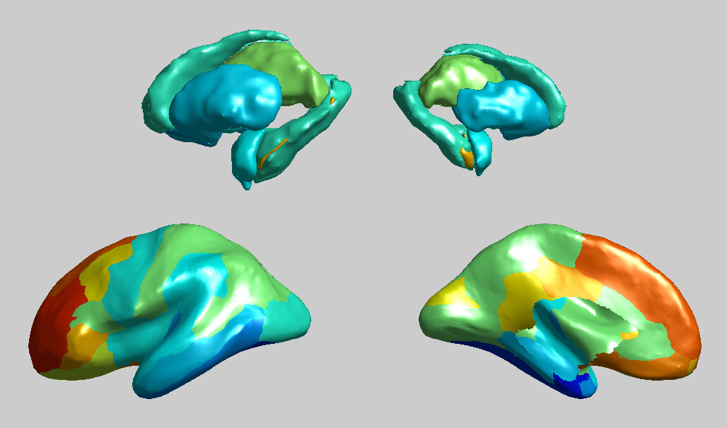 How Autism Changes Brain Scans Of >> Autism Brains Show Widespread Alterations In Structure Spectrum How Autism Changes Brain Scans Of >> Autism Brains Show Widespread Alterations In Structure Spectrum