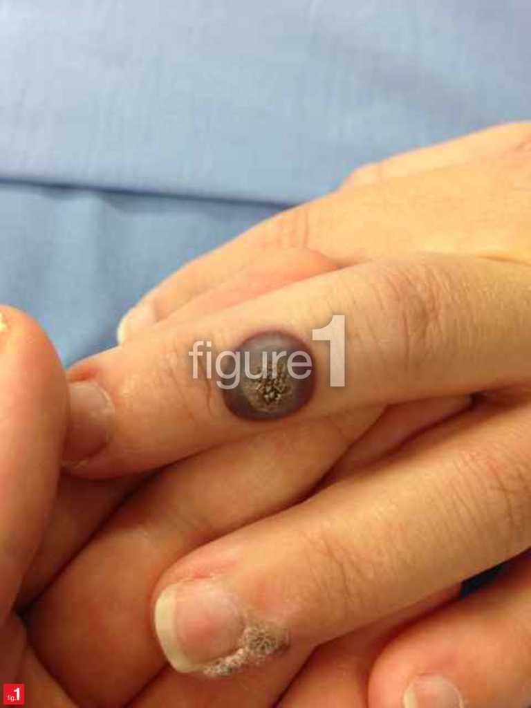 Blood blister after cryotherapy on wart on finger blister wart diagram 
