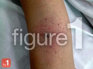 Dengue fever diagnosed by tourniquet test