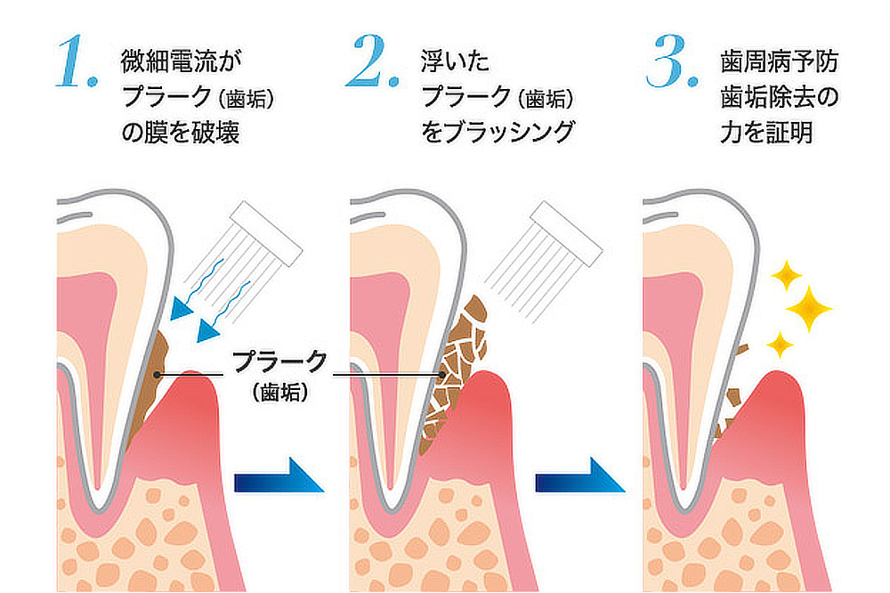 周波数1000万ヘルツの電流が、最も歯垢の除去力が高いことを発見。交流電流で歯垢の膜（バイオフィルム）を崩し、直流電流で歯垢を歯の表面から浮かせるという、シナジー効果を利用しています。｜世界初、刺激・振動なしの電子歯ブラシ｜PLAQLES（プラクレス）