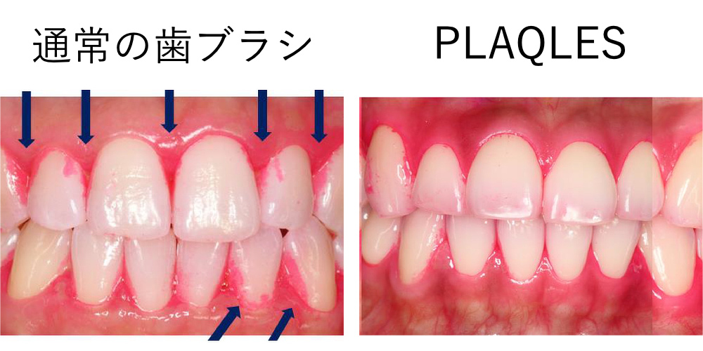 画期的なのは、毛先が届きにくい場所の歯垢にもアタックできること。ブラシから半径1cmの範囲に電流が伝わるため、スキマや境目、凹みなどの磨き残しが軽減。｜世界初、刺激・振動なしの電子歯ブラシ｜PLAQLES（プラクレス）