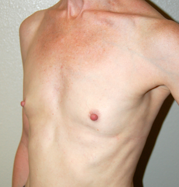 Before Breast Augmentation