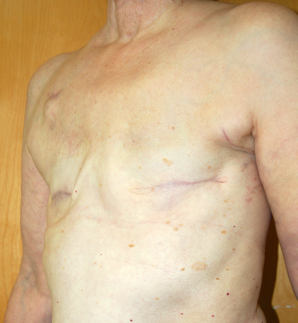 Before Breast Reconstruction Implants