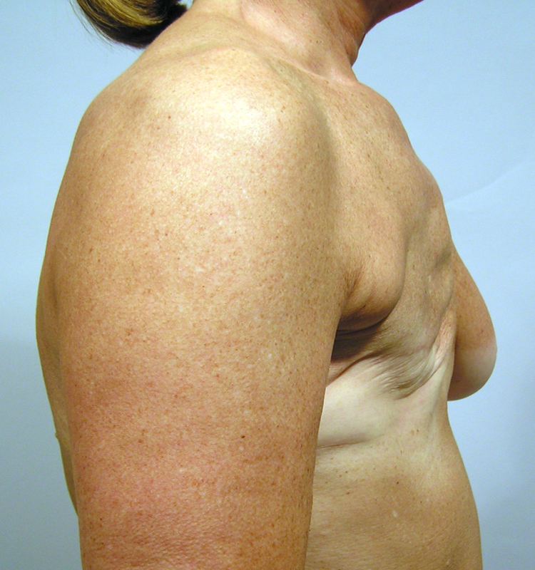Before Breast Reconstruction Implants