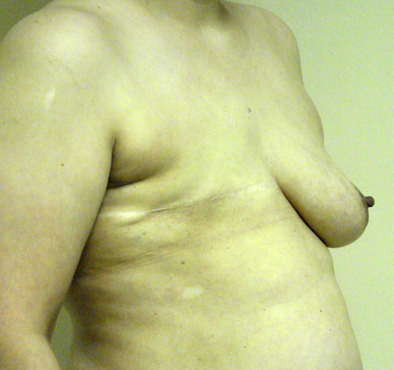 Before Breast Reconstruction Implants