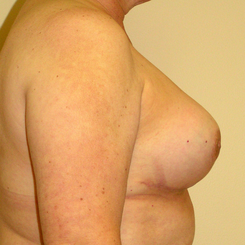 After Breast Revision