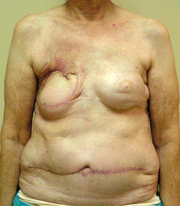 Before Breast Revision