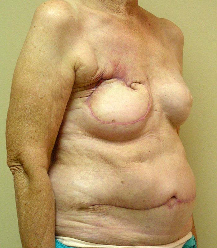 Before Breast Revision