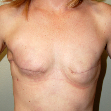 Before Breast Revision