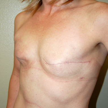 Before Breast Revision