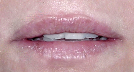 After Lip Augmentation